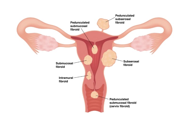 Labelled diagram of the uterus showing where different types of fibroid grow: submucosal, intramural, subserosal and pedunculated