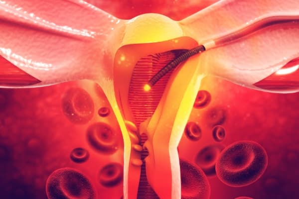 Illustration of a catheter positioned inside a uterine artery among red blood cells