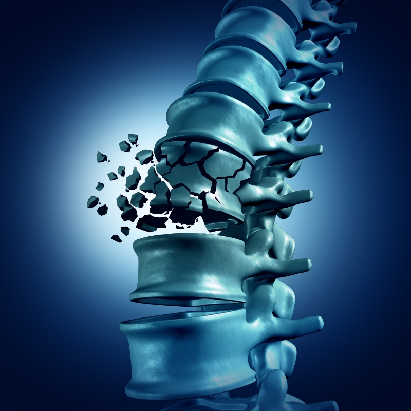 Rendering of the lower spine with one vertebral body collapsed and fragmenting